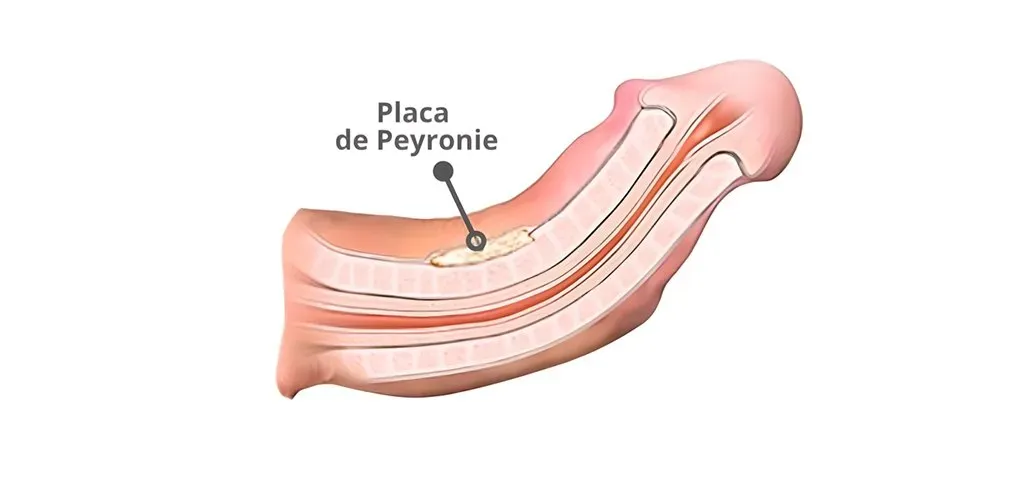 Doença de Peyronie: causas, diagnóstico e tratamento